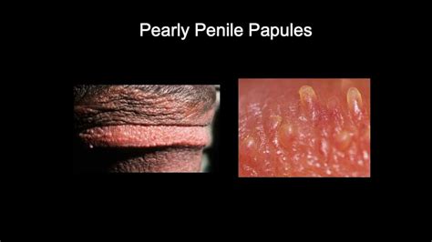 Pearly Penile Papule